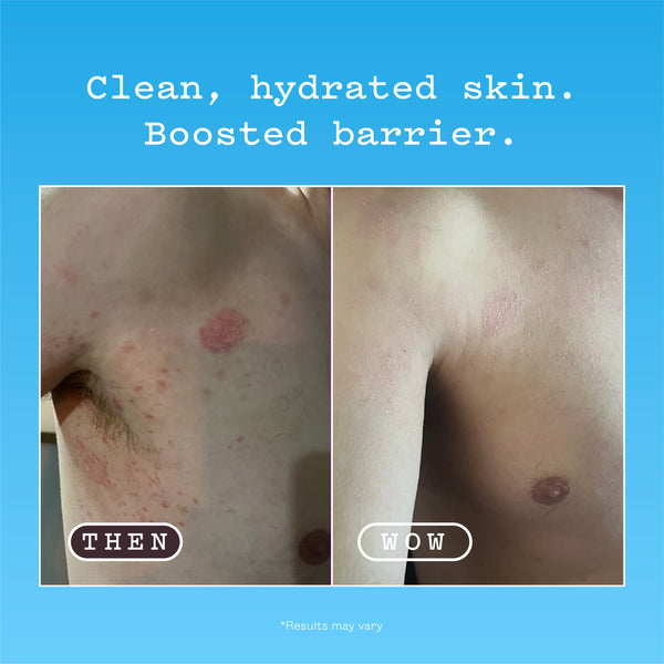 Ceramide Barrier Body Wash before and after. Left panel labelled THEN is the before: red, irritated patches on the chest. Right panel labelled WOW is the after: the same area looking calm and clear. Text reads: Clean, hydrated skin. Boosted barrier. Results may vary.