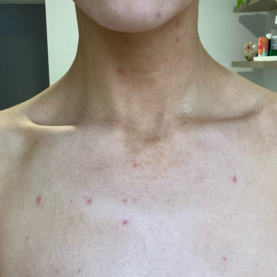 Before image for frank body Niacinamide Body Scrub: red spots and blemishes across the neck and chest.
