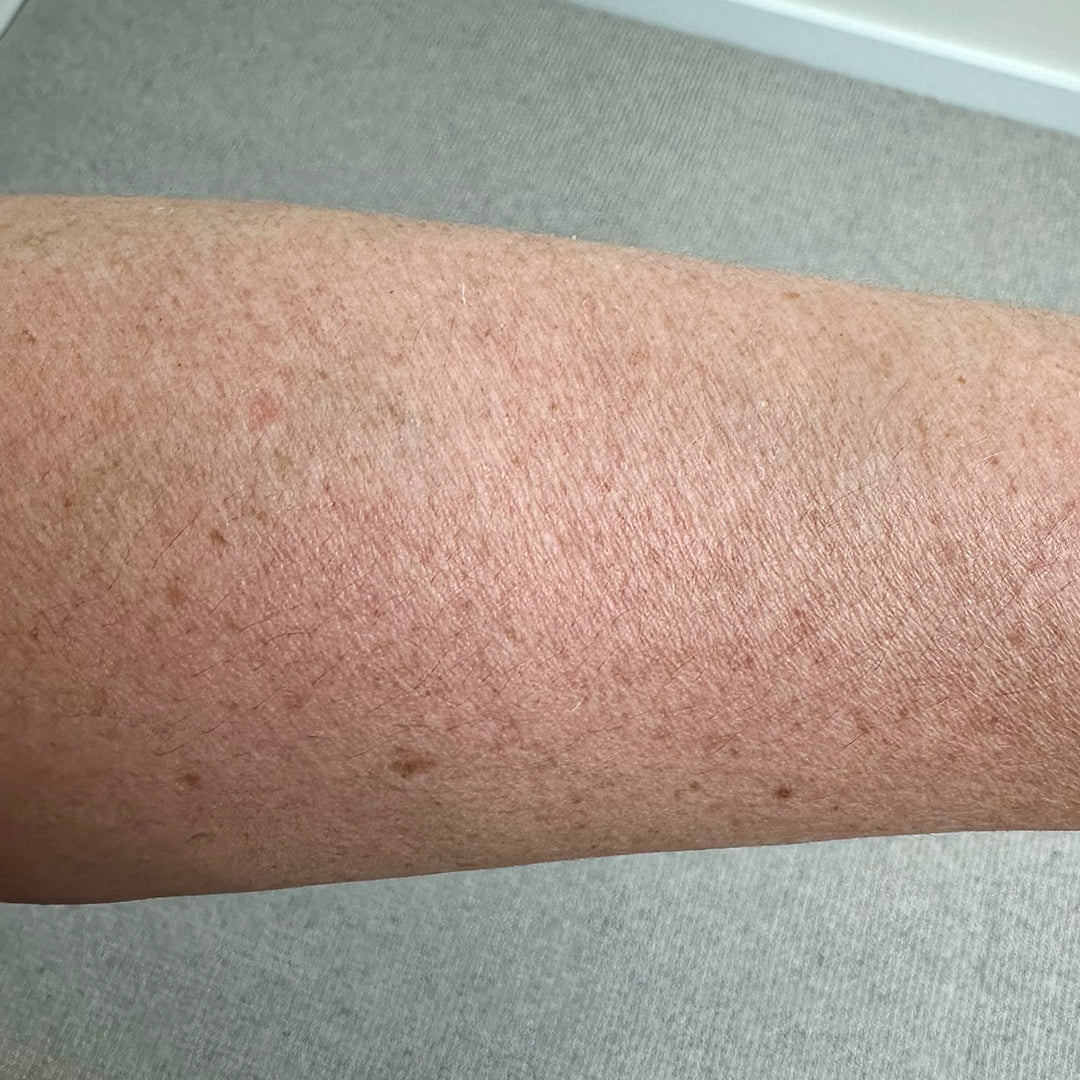 Before image for frank body Niacinamide Correcting Body Lotion: red, bumpy texture across the lower leg.